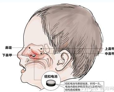 3岁孩童把纽扣电池塞进鼻孔里 嗅觉神经完全被破坏
