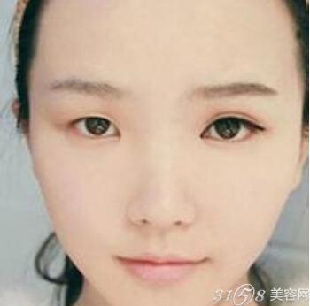 六步骤单眼皮肉泡眼瞬间变大-3158美容网