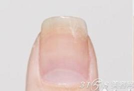 手指甲断了一半怎么办?图片
