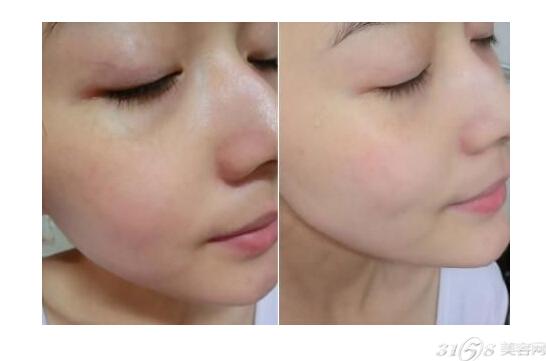点击图片查看详情 面部红血丝修复_如何修复面部红血丝