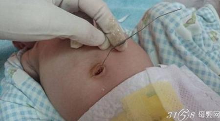 新生婴儿肚脐怎么护理