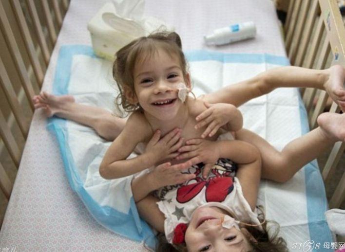 连体姐妹共用三条腿 手术后一方残疾
