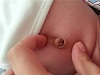 新生儿肚脐容易出现什么异常?