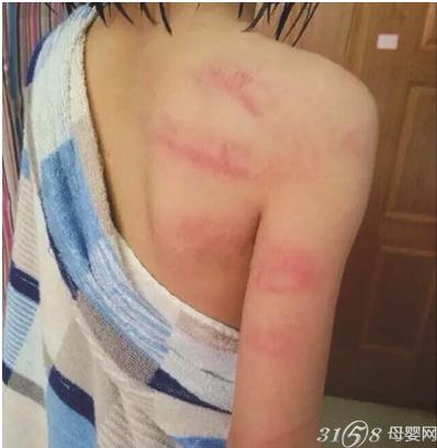 9岁女童遭殴打满背伤痕 原因竟然是